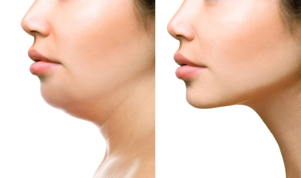 Kybella: Losing that Double Chin with Ease